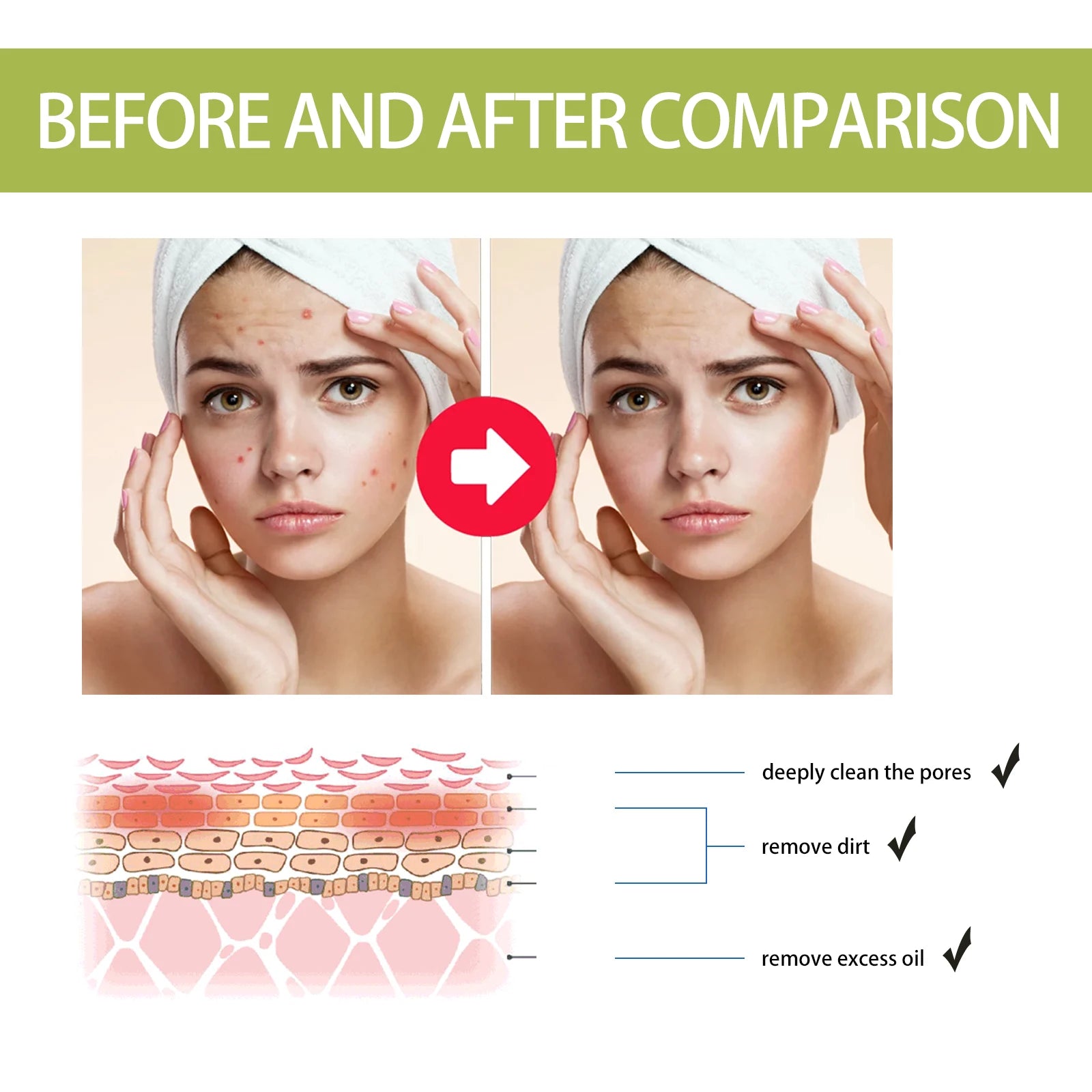 EELHOE Tea Tree Anti-Acne Essence