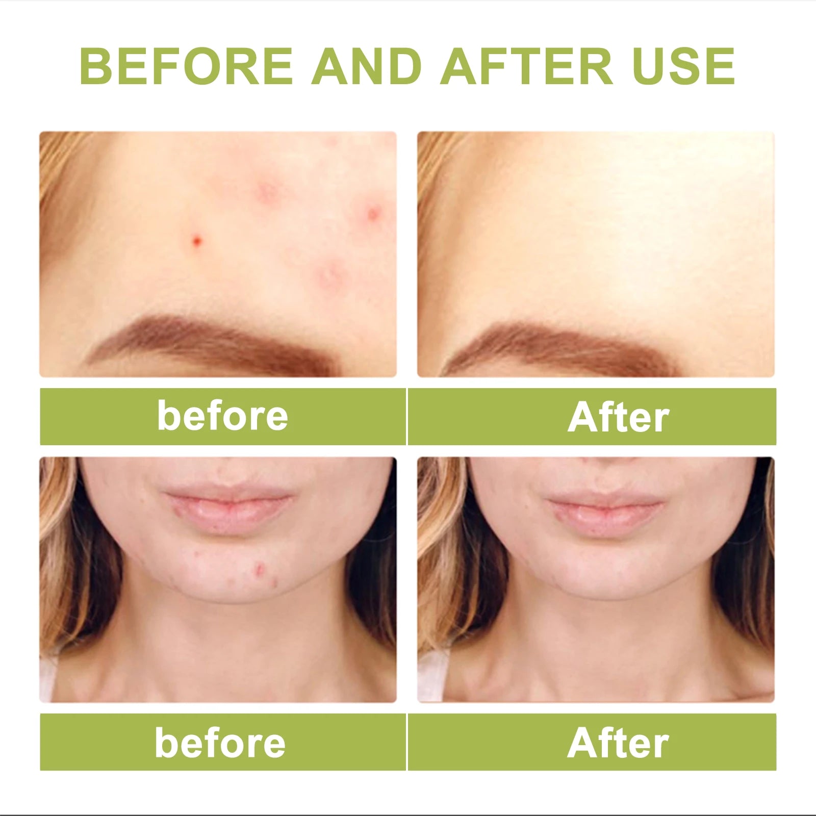 EELHOE Tea Tree Anti-Acne Essence