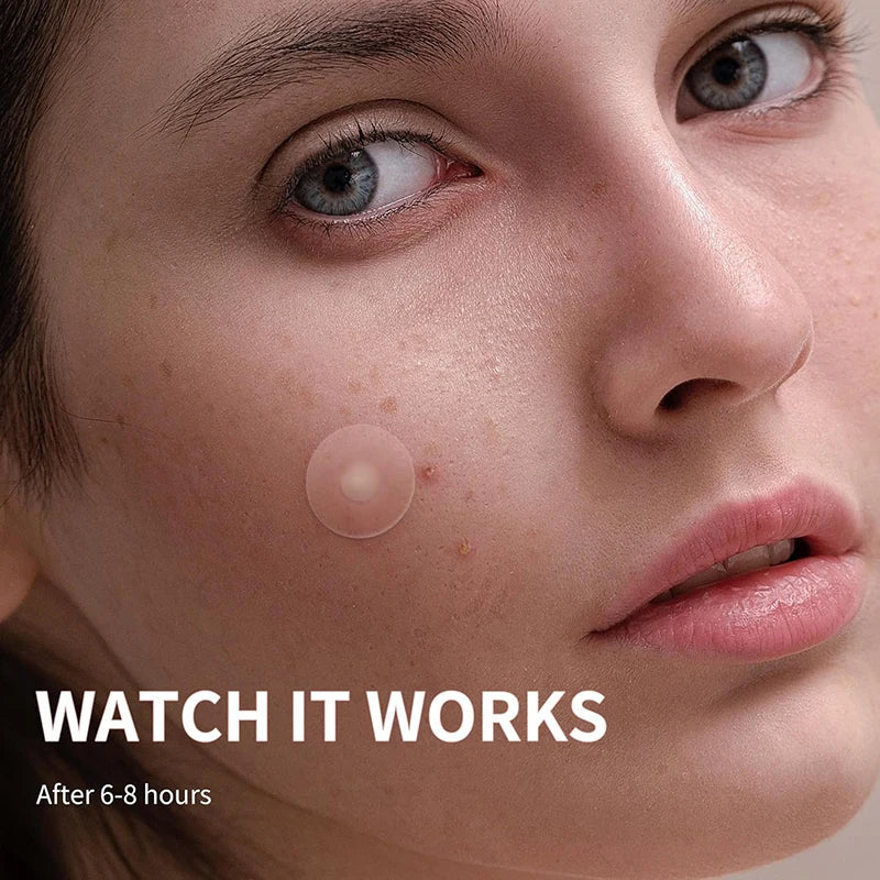 360pcs Invisible Hydrocolloid Acne Patches